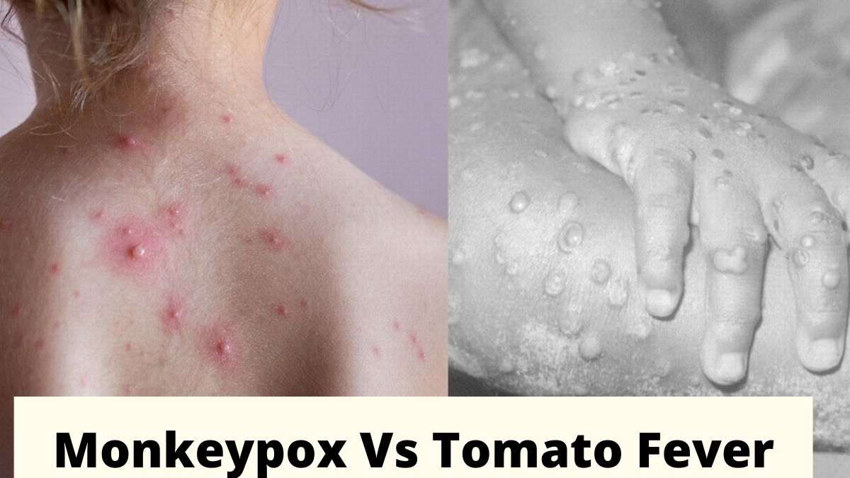 Monkeypox vs Tomato Flu